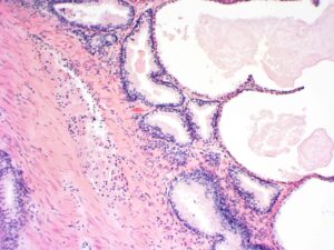 Prostata Gewebeprobe